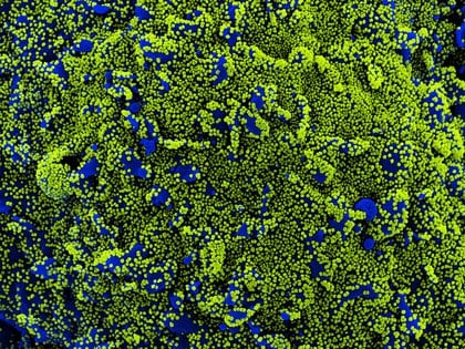 Células infectadas de coronavirus en azul. (NIAID/National Institutes of Health via The New York Times)