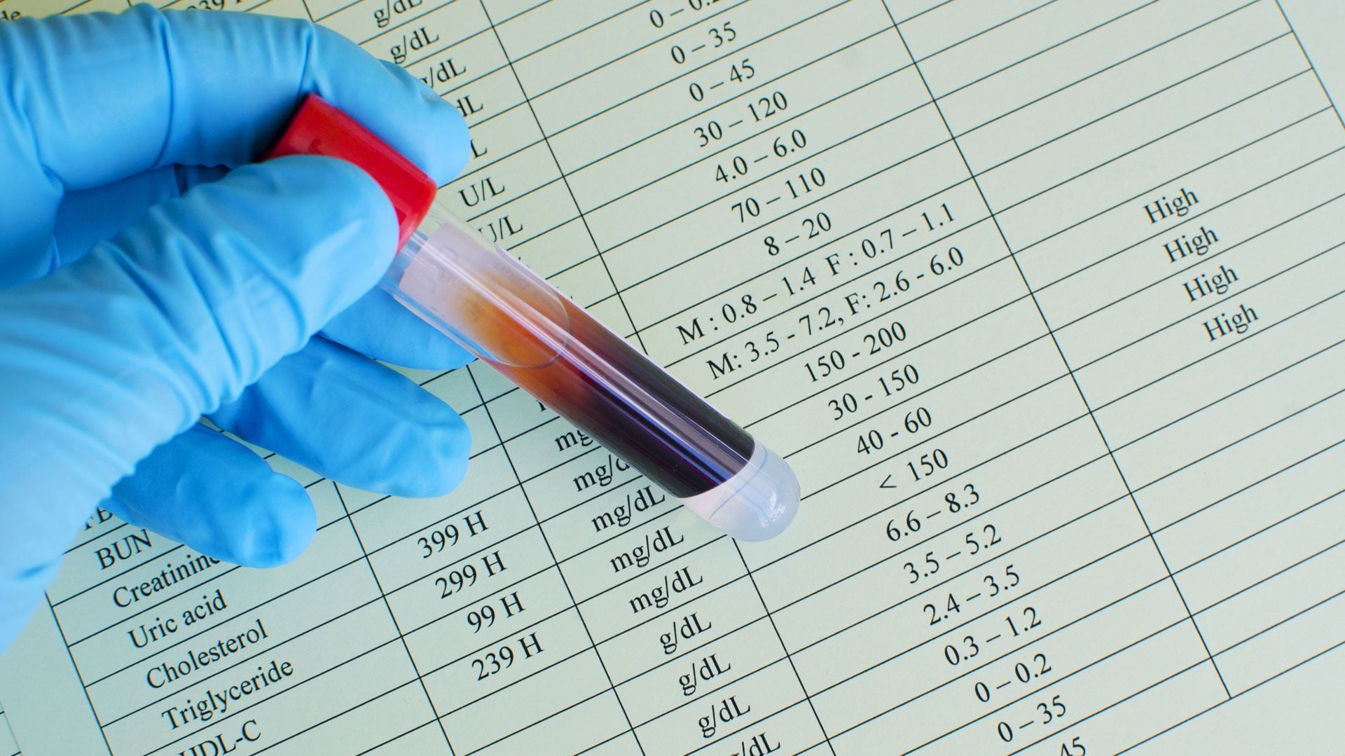 El colesterol elevado se diagnostica con un análisis de sangre de laboratorio