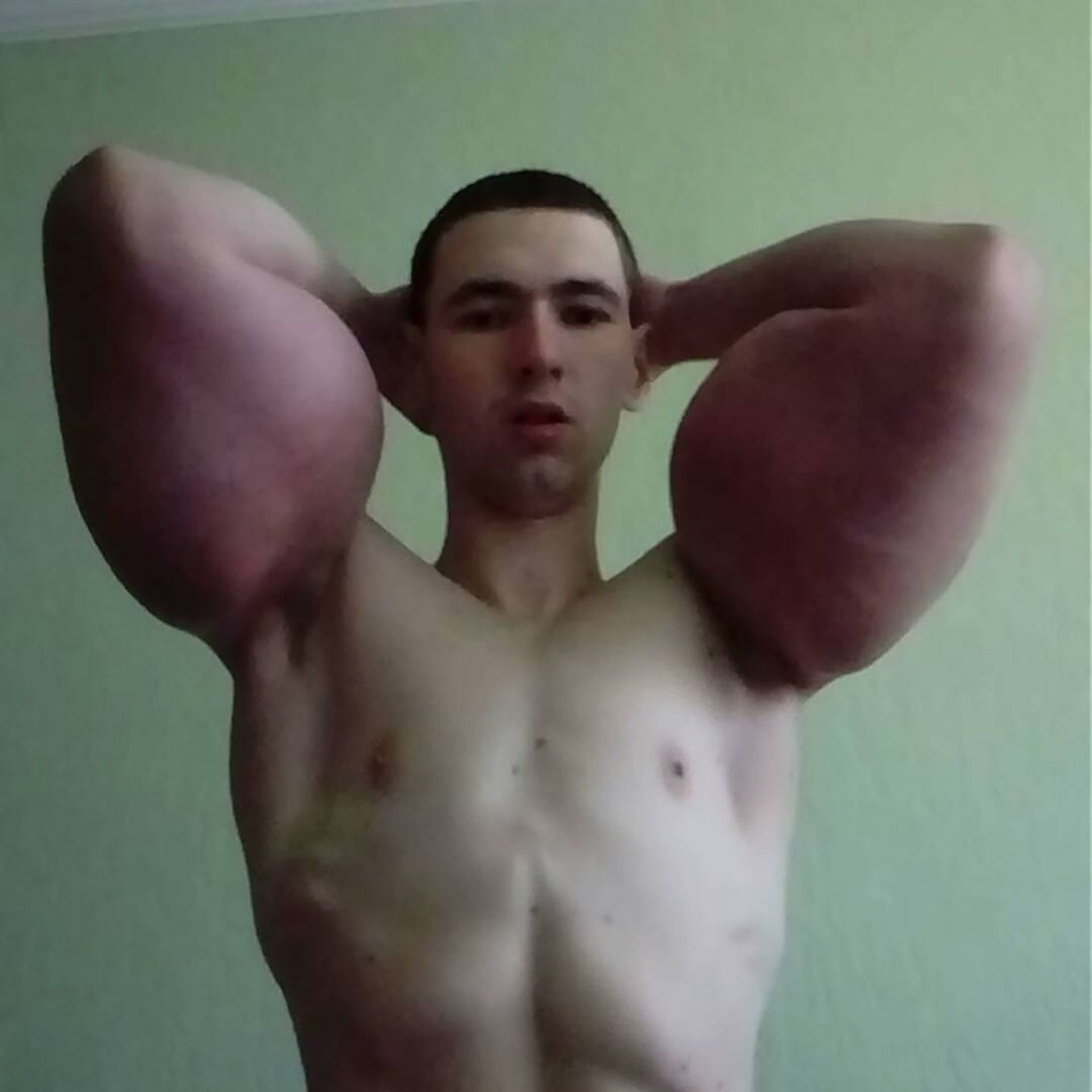 El "Popeye" ruso se inyectó Synthol en los brazos (@kirilltereshin96)