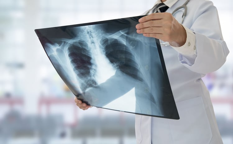 Se caracteriza por manifestar síntomas de infección aguda de las vías respiratorias bajas y por opacidades en la radiografía de tórax de aparición reciente y que no son explicables por otras causa (Shutterstock)
