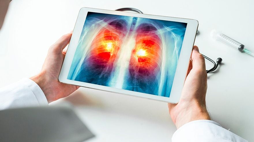 El objetivo final en un futuro es lograr que se activen programas nacionales de rastreo tomográfico para la detección precoz del cáncer de pulmón (Europa Press) 