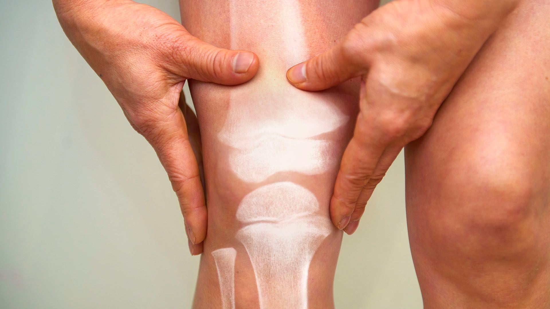 Es importante realizar una densitometría para establecer el tratamiento a seguir en caso de tener osteoporosis (Getty Images)