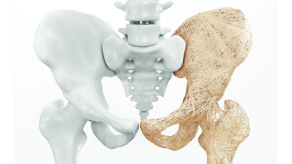 Los huesos se vuelven más frágiles y un golpe o caída, puede ocasionar en una fractura
(Ilustración: UNAM)