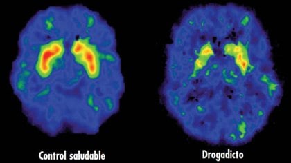 El cerebro adicto: cómo las drogas anulan las capacidades humanas - Infobae