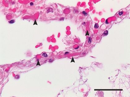 Otra investigación, publicada en NEJM, había observado en los pulmones de pacientes muertos por COVID-19 una gran cantidad de coágulos, que en la imagen señalan las flechas. (NEJM)