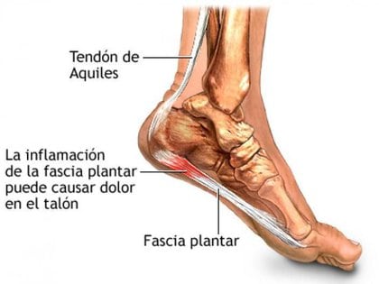 La fascitis plantar es la inflamación del tejido grueso de la planta del pie