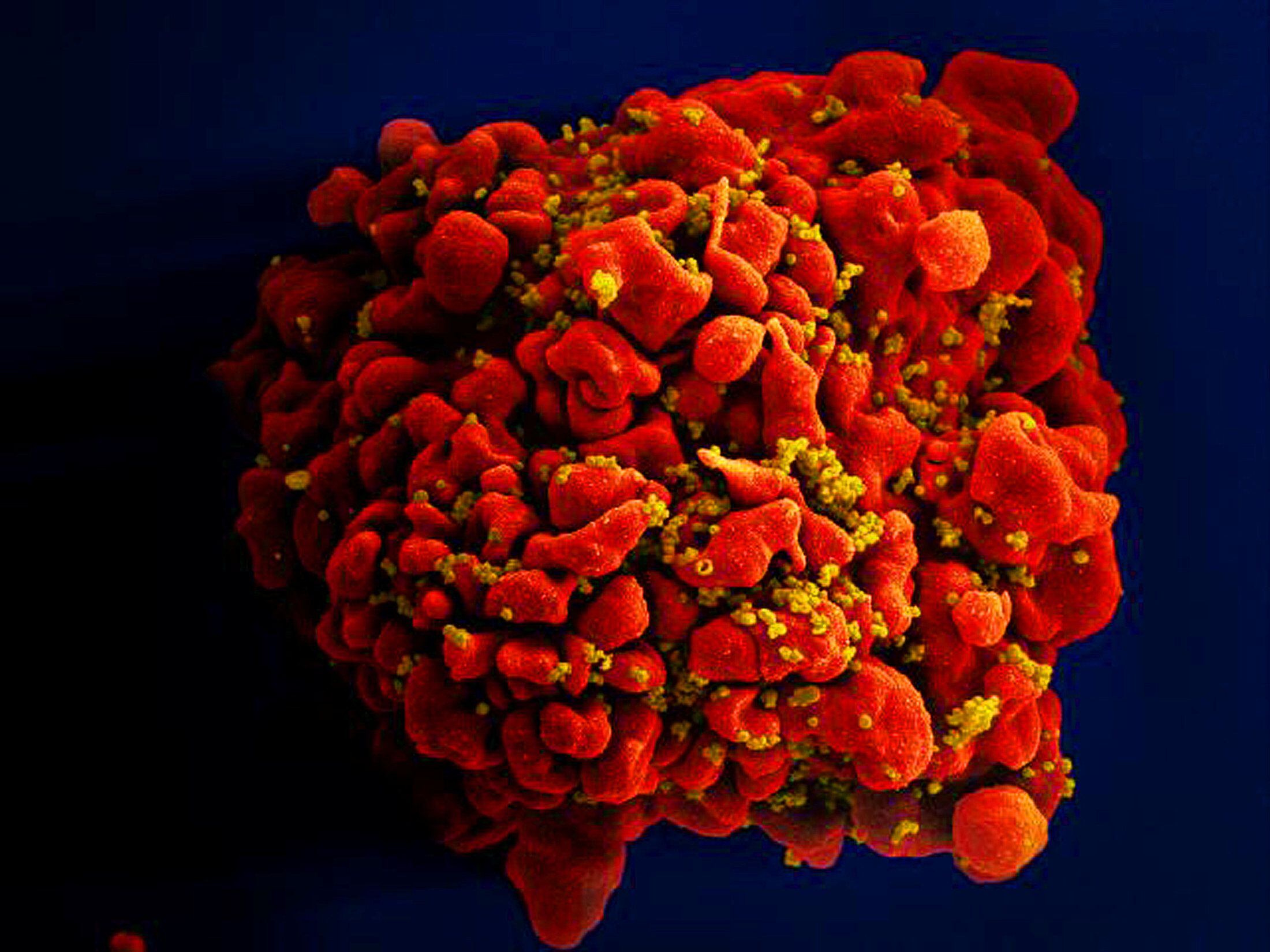 En 2020 se produjeron 1,5 millón de nuevas infecciones por el VIH (NIAID) (Handout via REUTERS /Archivo)