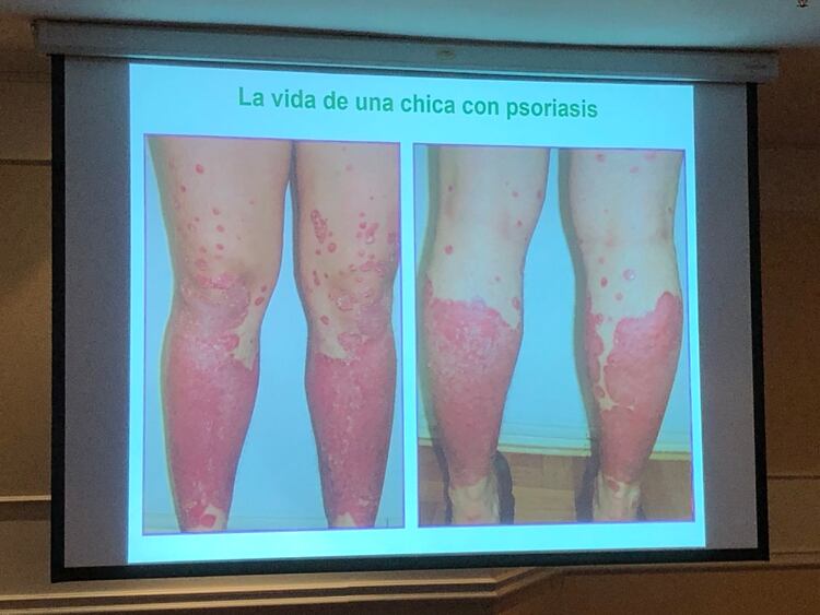 El caso de Laura, fue un ejemplo claro del impacto de la psoriasis en los más chicos