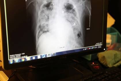 Los científicos franceses examinaron miles de radiografías de tórax a fines de 2019 y pudieron identificar dos escáneres que eran consistentes con los síntomas de COVID-19, dos meses antes del primer caso reportado (REUTERS/Lucy Nicholson)