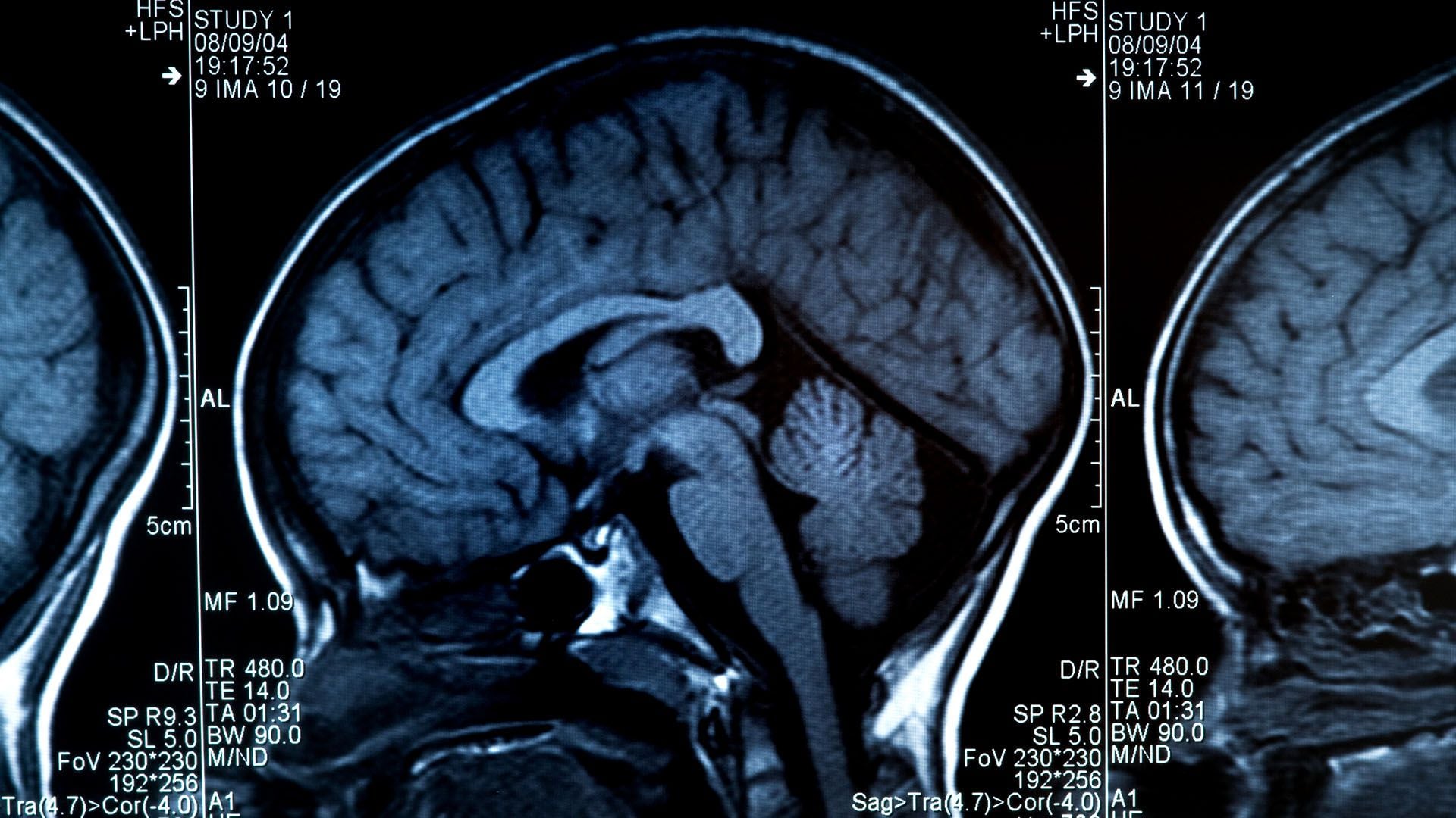 En 2020 murieron 251.329 pacientes por tumores cerebrales, según el registro de la Agencia Internacional del Cáncer, que depende de la Organización Mundial de la Salud / Getty  