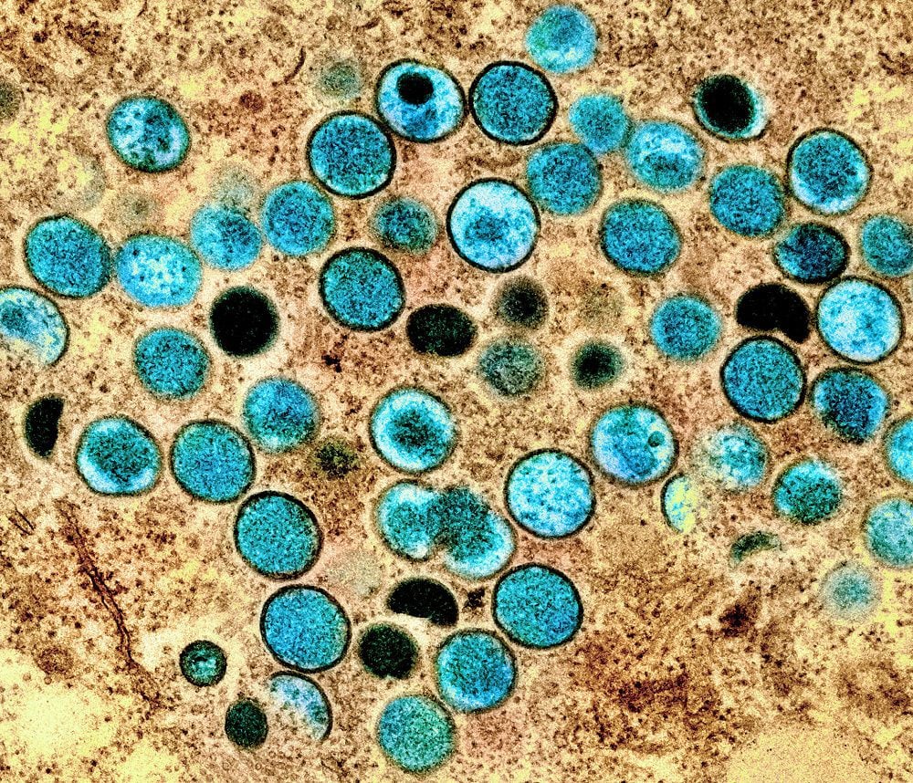 Colorized transmission electron micrograph of monkeypox particles (teal) found within an infected cell (brown), cultured in the laboratory. Image captured and colour-enhanced at the NIAID Integrated Research Facility (IRF) in Fort Detrick, Maryland.  CREDIT National Institute of Allergy and Infectious Diseases (NIAD).