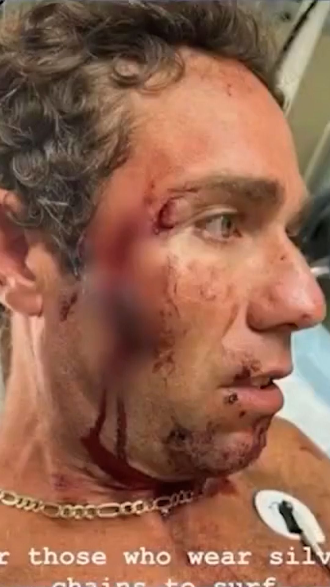 Un tiburon le mordió la cara a un surfista