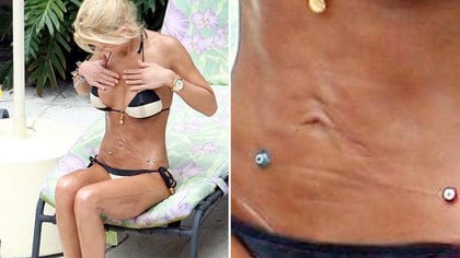 A Tara Reid, una cirugía le dejó cicatrices en el abdomen