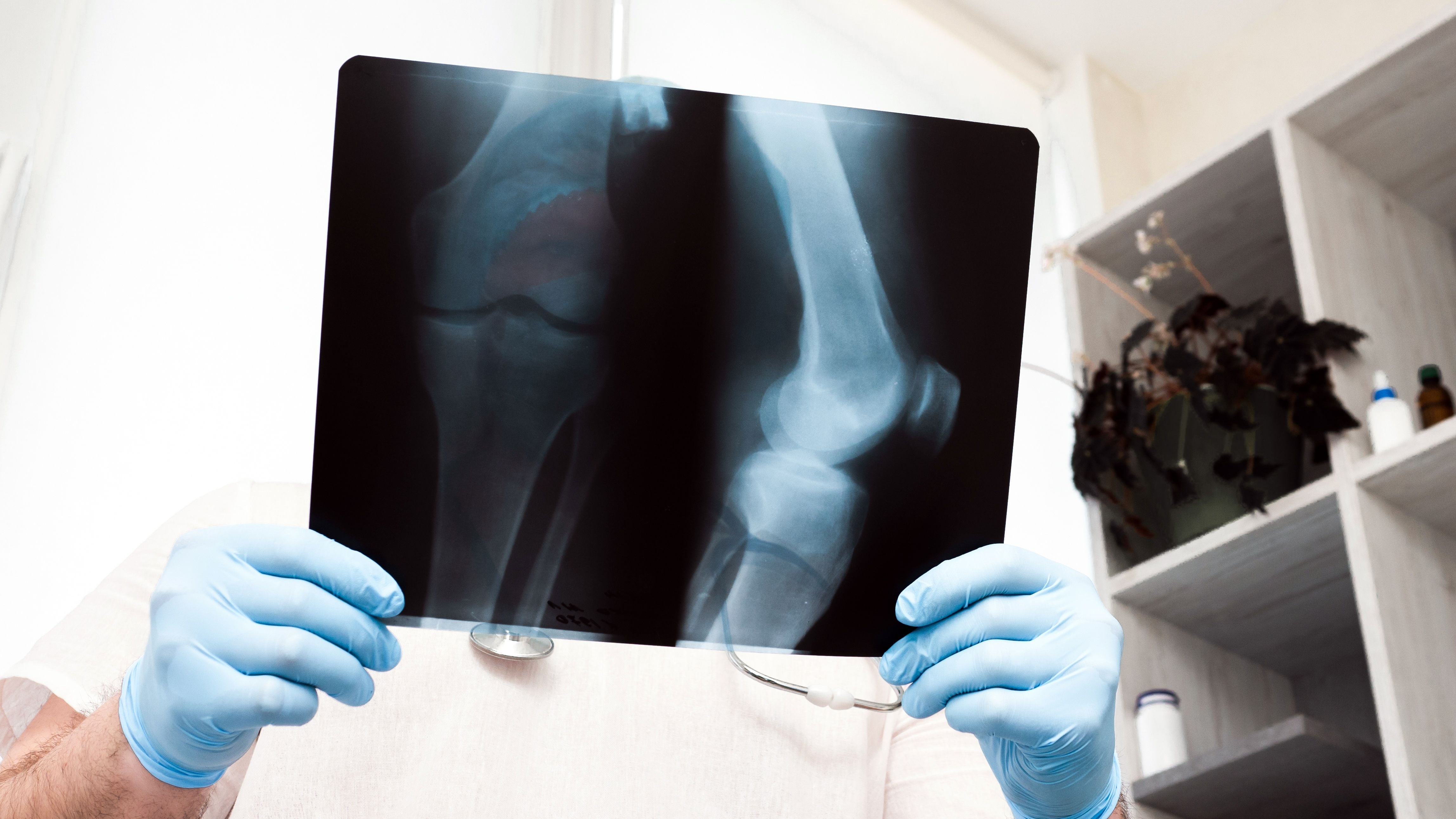 Traumatólogo observa unos rayos X (Shutterstock)