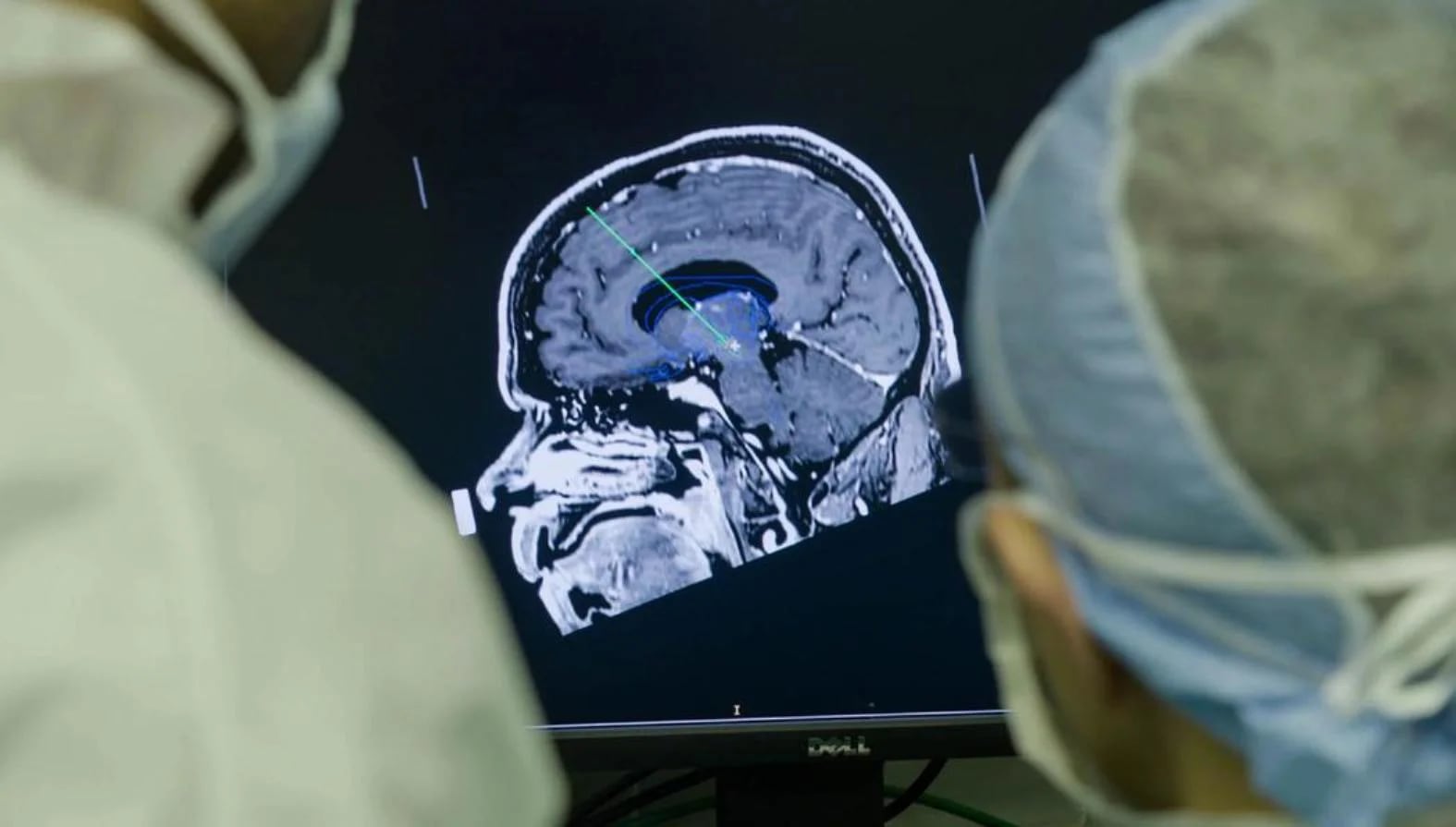 Los doctores de la Universidad Estatal de Ohio en una operación de implante cerebral profundo similar a la que se sometió Ian.