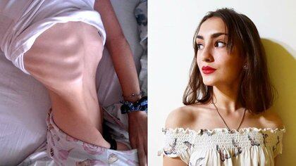 Mostró el impacto de la anorexia en su cuerpo y la foto se volvió viral:  “Decidí vivir” - Infobae