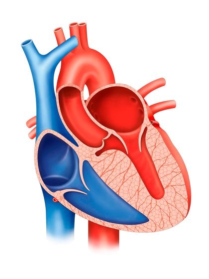 En la miocardiopatía hipertrófica, la pared muscular entre las dos cámaras inferiores del corazón se vuelve más gruesa de lo normal. Como resultado, la pared más gruesa puede bloquear el flujo de sangre fuera del corazón
