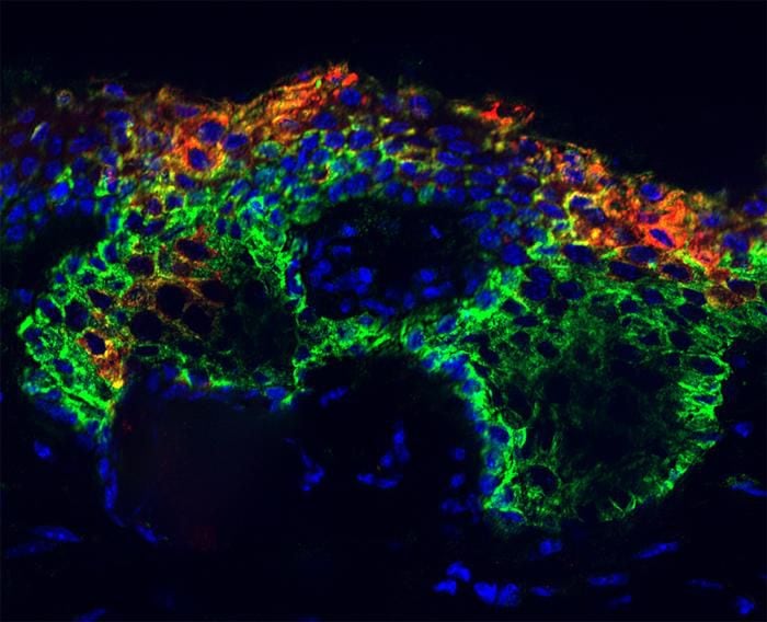 Esta imagen fue capturada por científicos de EE..UU. Son lesiones (en verde) similares al carcinoma basocelular inducidas por SOX9 en la epidermis. La diferenciación anormal se muestra en rojo, y el azul marca los núcleos celulares/
CRÉDITO Robin Chemers Neustein Laboratorio de Biología Celular y Desarrollo de Mamíferos de la Universidad Rockefeller
