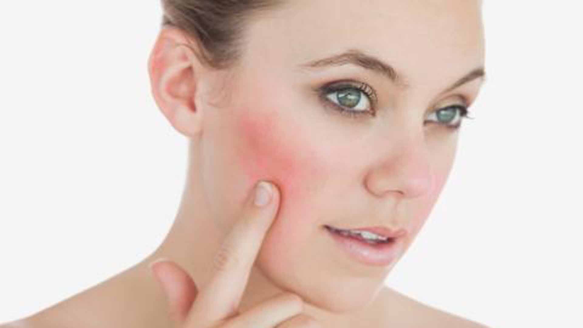 A diferencia del acné, la rosácea causa rubor o enrojecimiento y vasos sanguíneos visibles en la cara (Getty)