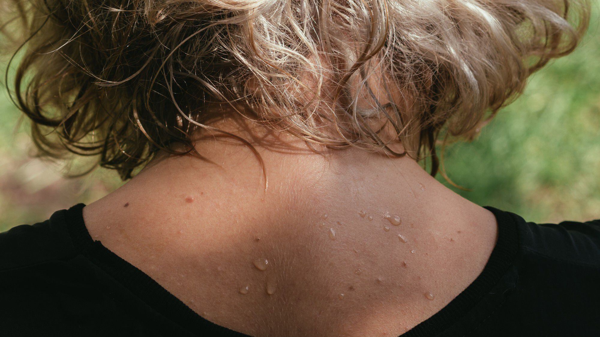 La nueva piel podría ayudar a las personas con sudoración excesiva