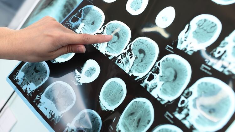 No existe en la actualidad un tratamiento curativo de la enfermedad de Alzheimer (Shutterstock)