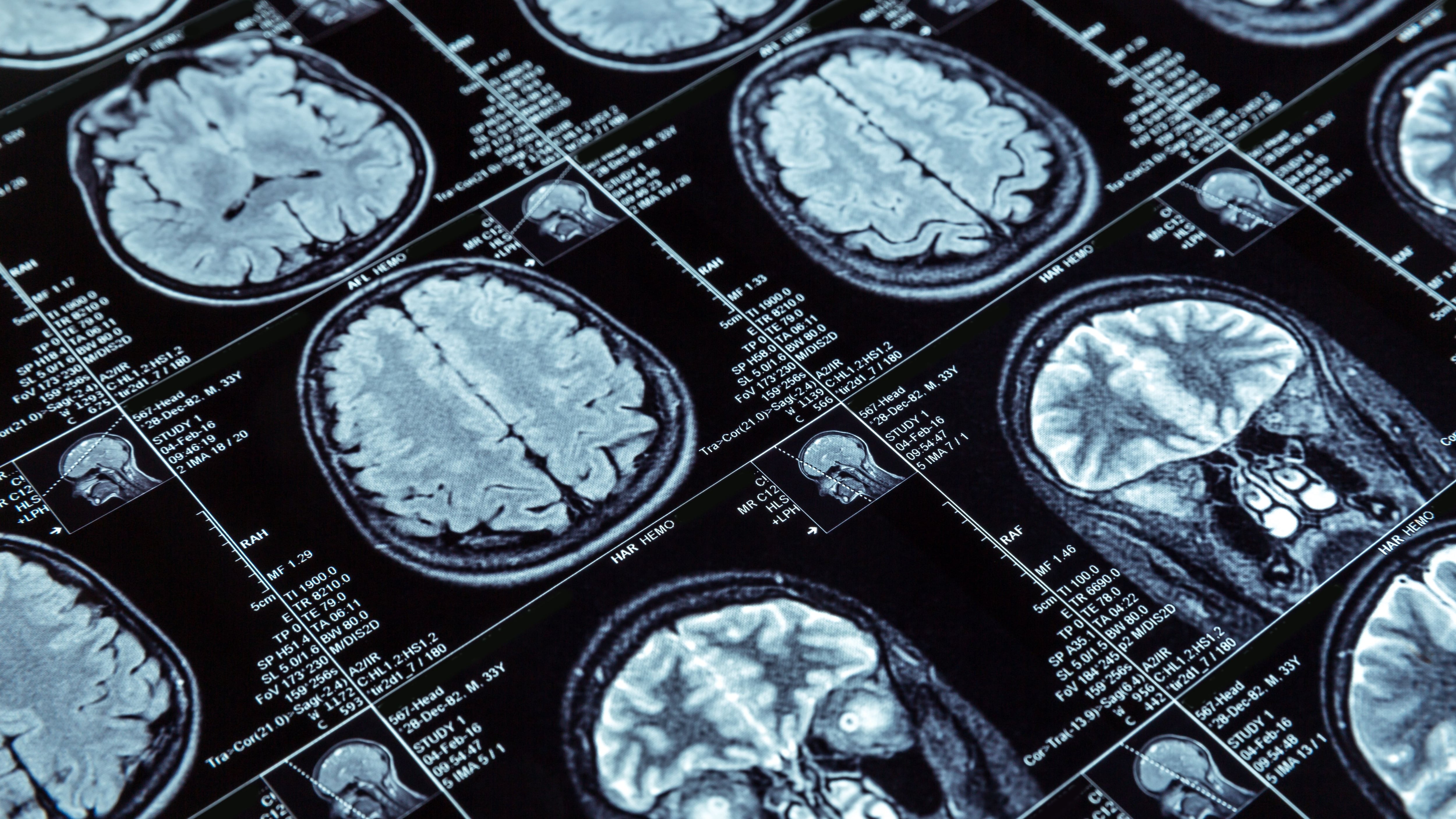 Resonancia magnética del cerebro (Shutterstock)