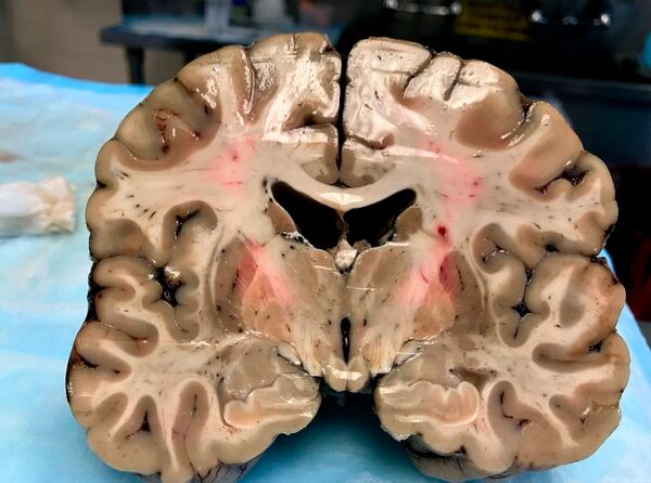 El cerebro de un joven de 27 años que se colgó en abril en su celda (Boston University)