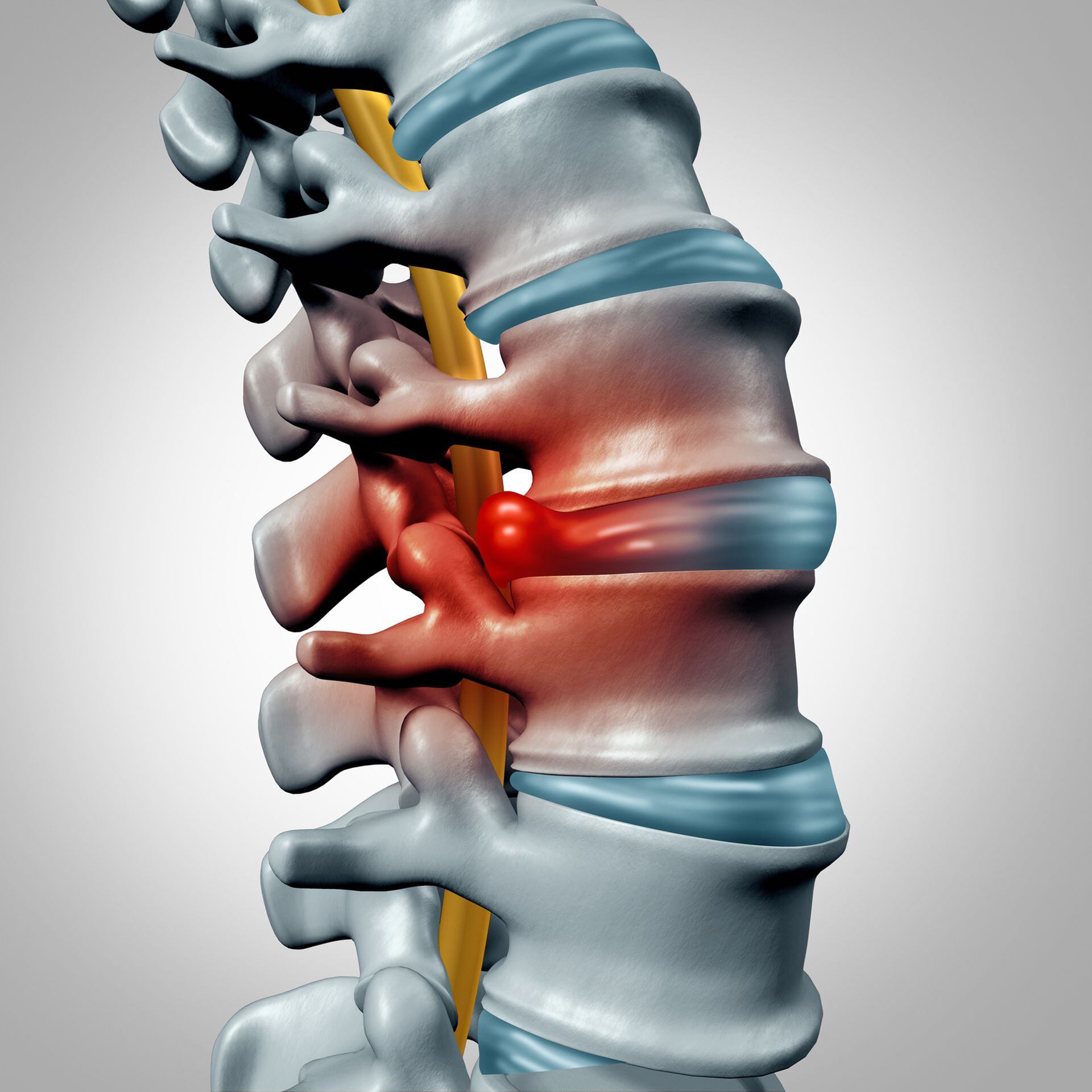 Generalmente, el dolor de espaldas es benigno y se va, o con el tiempo, o se va con tratamientos que le puede indicar su médico /
