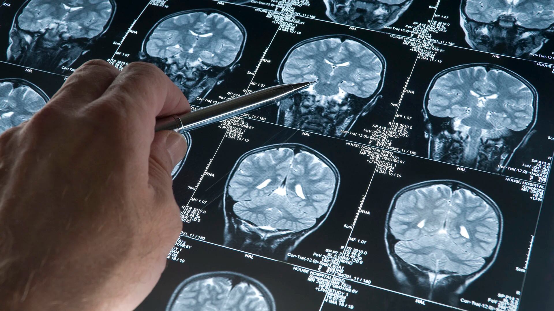 El Alzheimer afecta a más de 50 millones de personas en el mundo, y el envejecimiento de la población hace que puedan ser muchas más en las próximas décadas
(Getty Images)