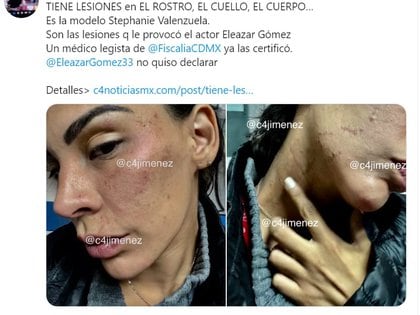 Imágenes de las heridas que el actor le habría causado a su novia