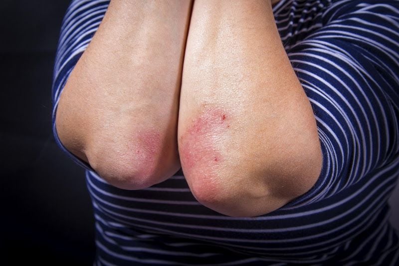 Norit - Hoy es el día mundial de la Dermatitis atópica, un trastorno que  provoca el enrojecimiento de la piel y picazón🔥. Aunque por supuesto lo  que te recomendamos es que vayas