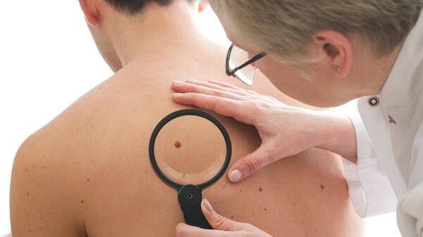 Los lunares son fundamentales en la detección de un melanoma (iStock)