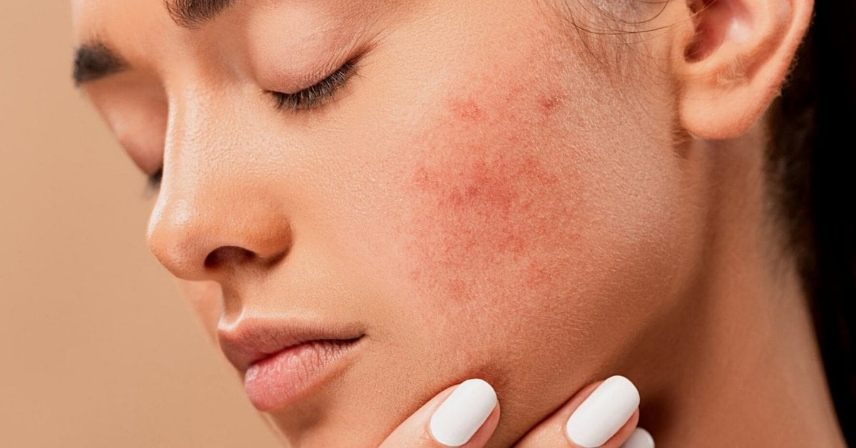 The most Effective active ingredients to improve Acne in Pandemic