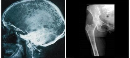 Lesiones osteolíticas características en los pacientes con Mieloma Múltiple 
