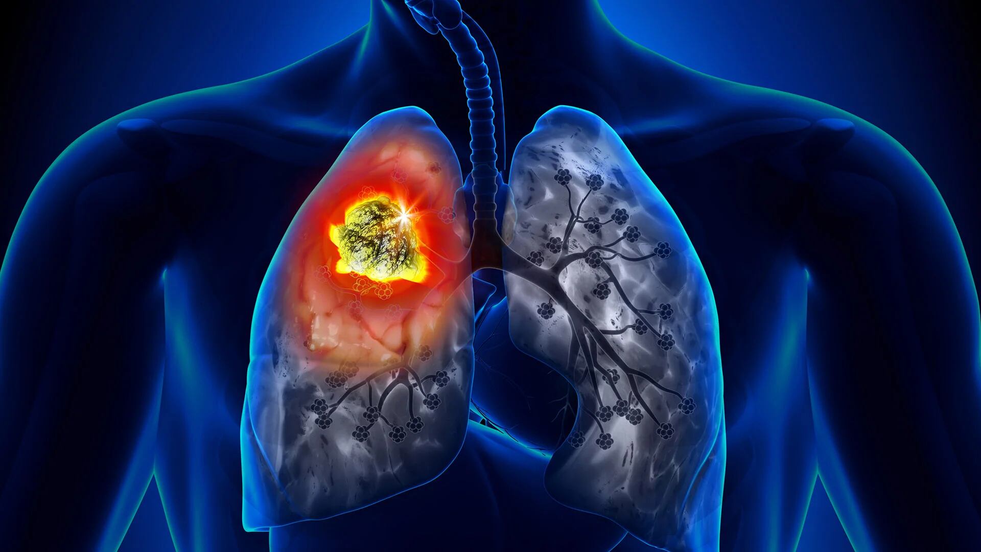 Paciente al que le descubrieron un nódulo en el pulmón (Shutterstock)