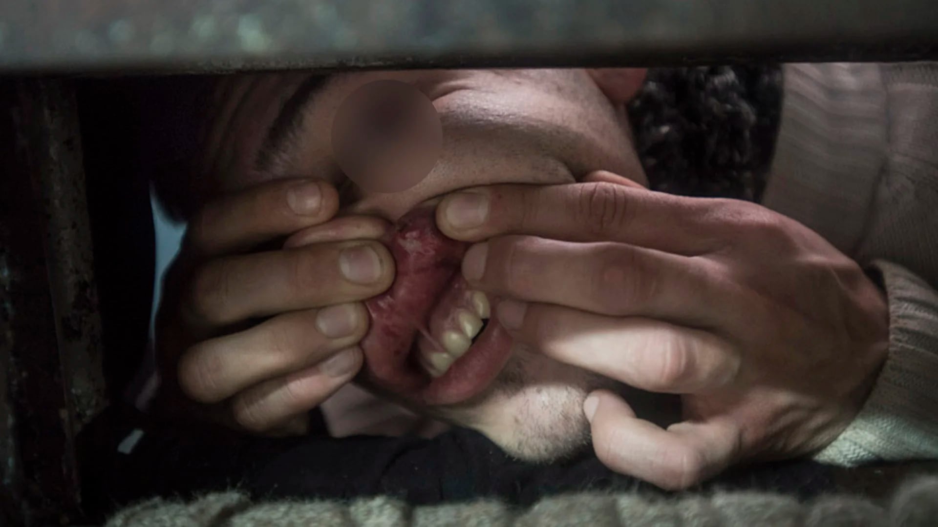 Olmos: un preso muestra una infección en la boca sin tratamiento.