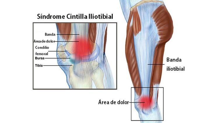 Este síndrome también es llamado de la cintilla iliotibial