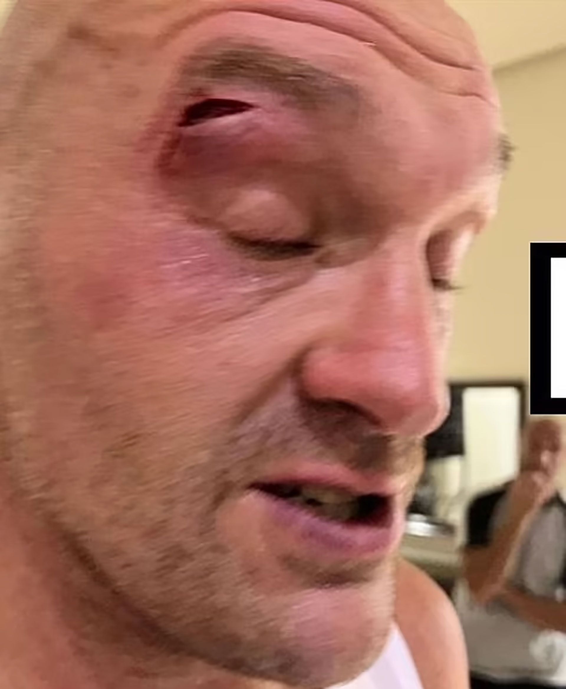 La lesión de Tyson Fury