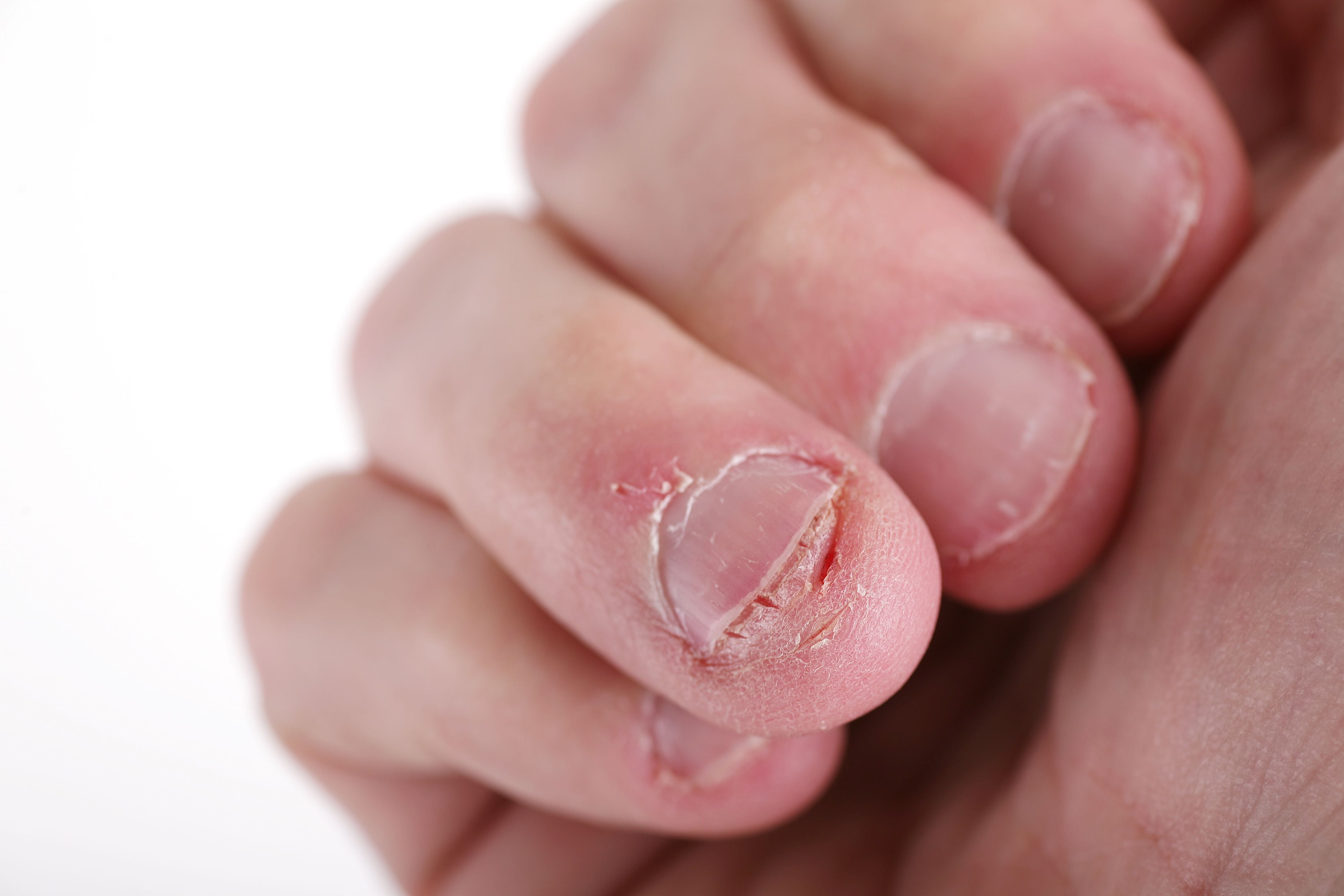 Las personas que se comían las uñas y dejaron de hacerlo tienen una forma distintiva que, en algunos casos, puede ser un indicio de una infección en las válvulas cardíacas
(Getty Images)