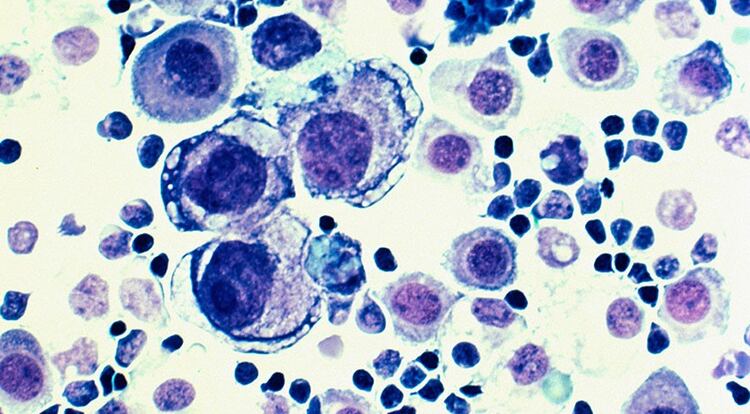 Células de un cáncer mama (University of Michigan)