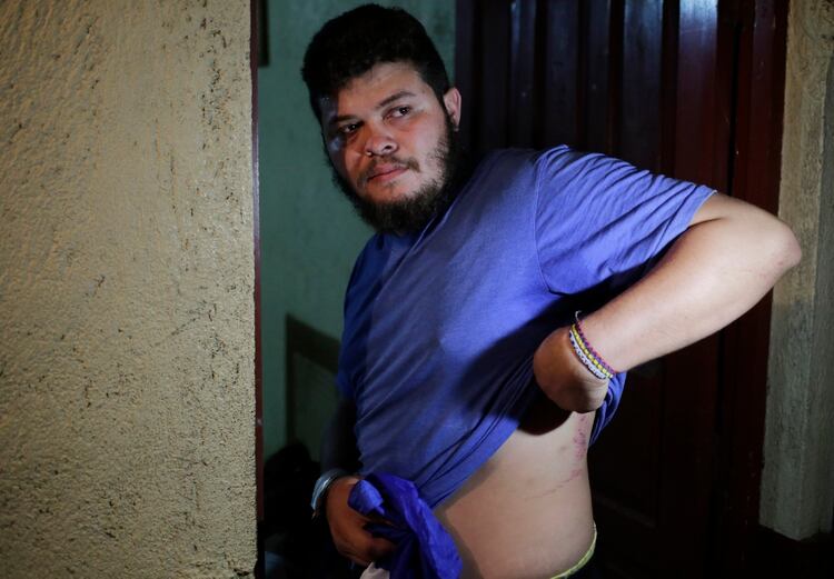 Chester Navarrete muestras las heridas que el régimen le causó durante su encierro en la cárcel de La Modelo (INTI OCON / AFP)