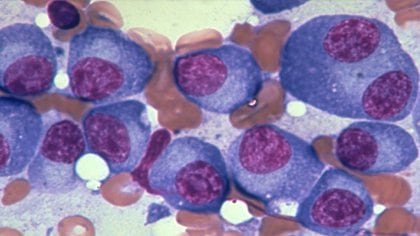 El mieloma múltiple se forma por el crecimiento anormal y acelerado de los plasmocitos, dañando a las células encargadas de producir anticuerpos para proteger al organismo