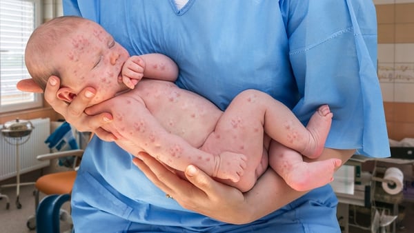 El Ministerio de Salud confirmó dos casos de sarampión en bebés de cinco y seis meses (Getty)