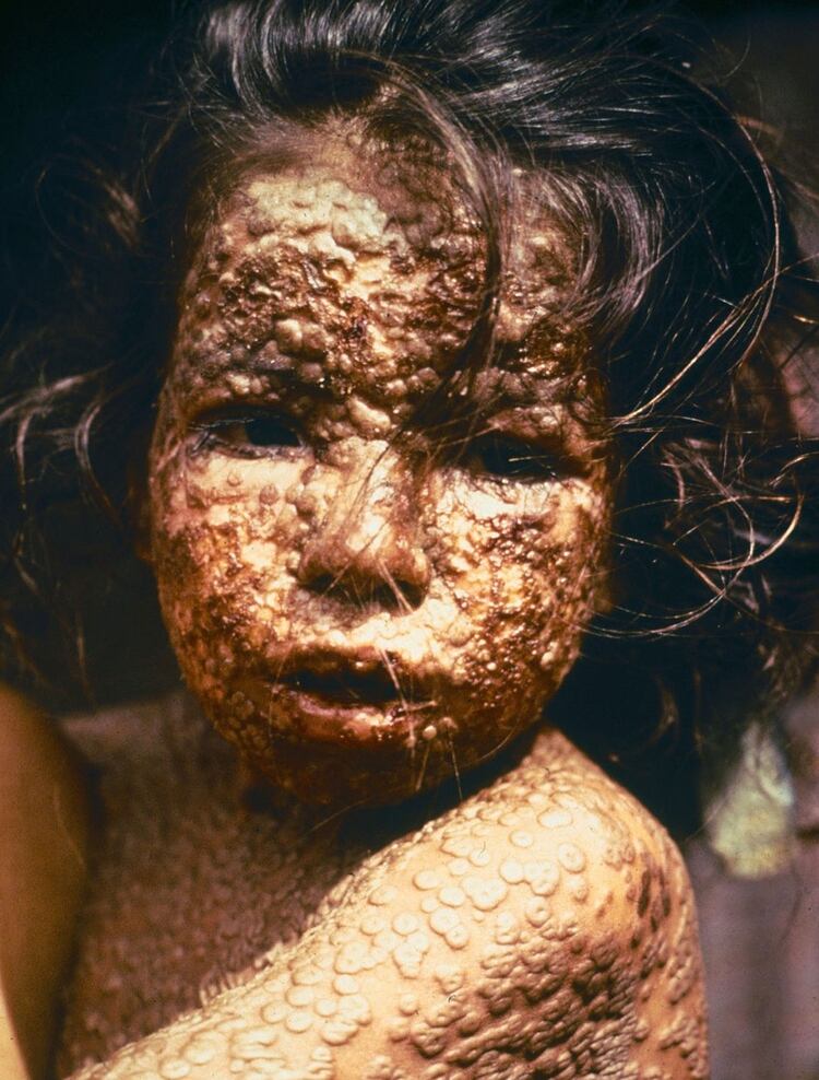 Una niña afectada con viruela, en 1973