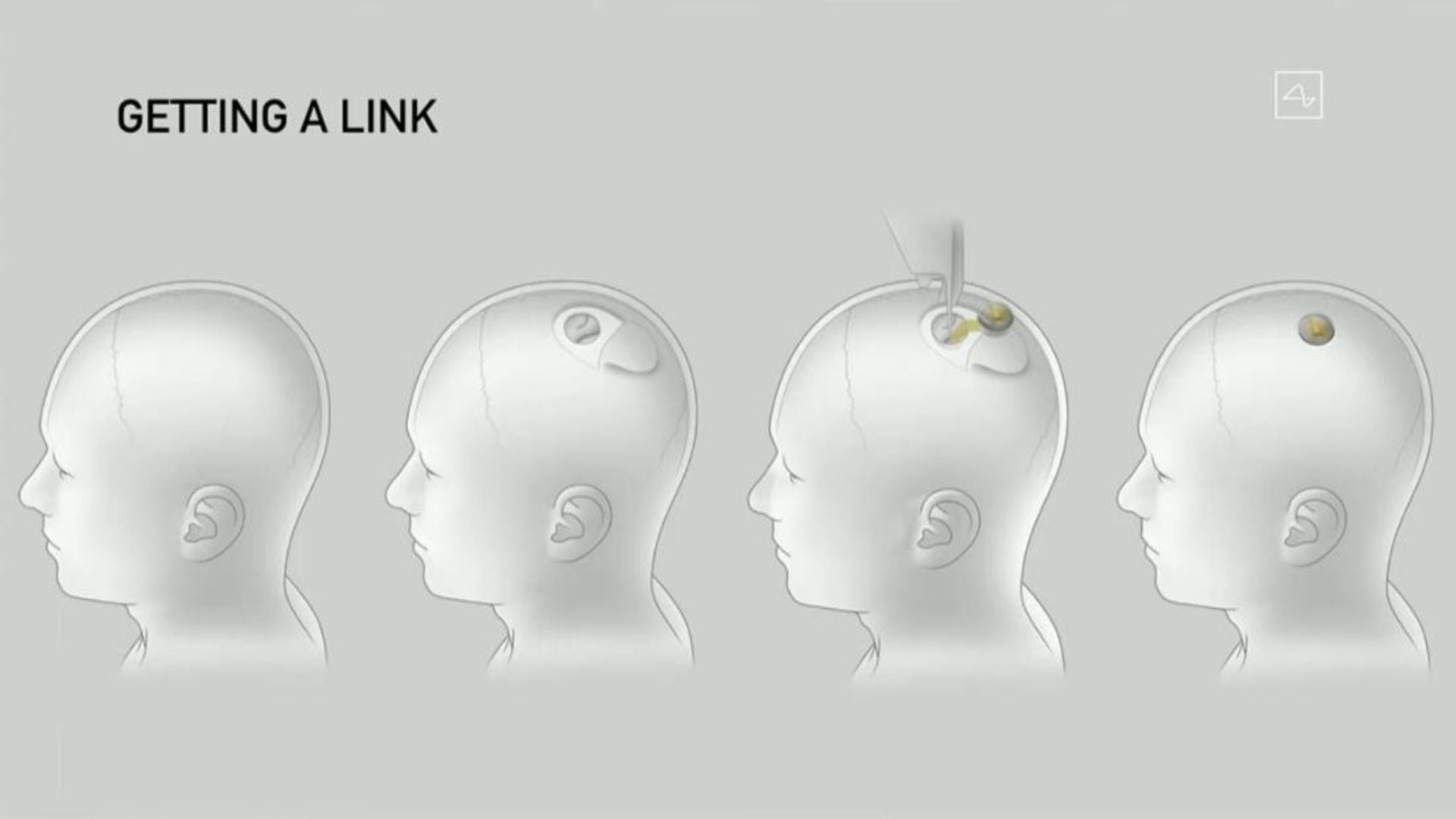 Los pacientes interesados en recibir el implante de Neuralink deberán tener impedimentos para moverse, hablar, escuchar o ver, además de ser residentes en Estados Unidos. (Neuralink)