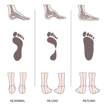 Los distintos tipos de apoyo del pie