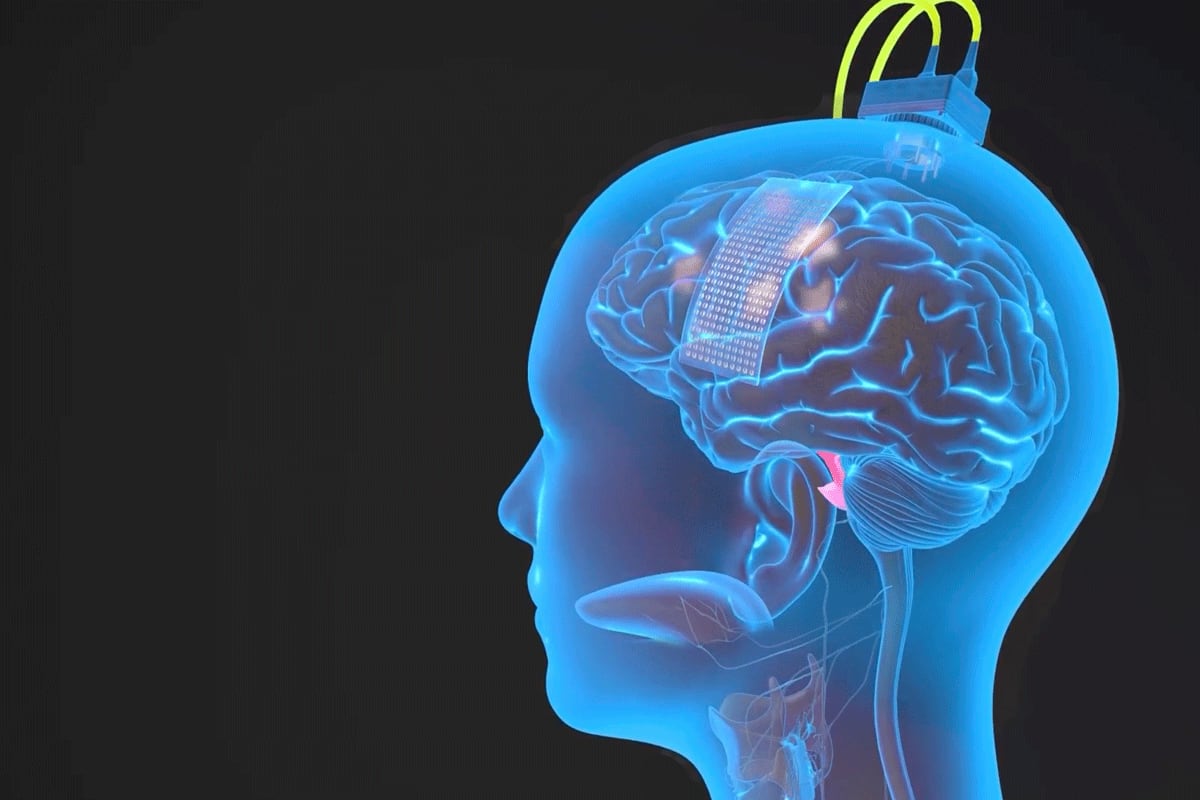 El doctor Edward Chang, de la Universidad de San Francisco en California, implantó el delgado rectángulo de electrodos en la superficie del cerebro de Ann para captar las señales enviadas a los músculos del habla. Ilustración (UCSF /Ken Probst)