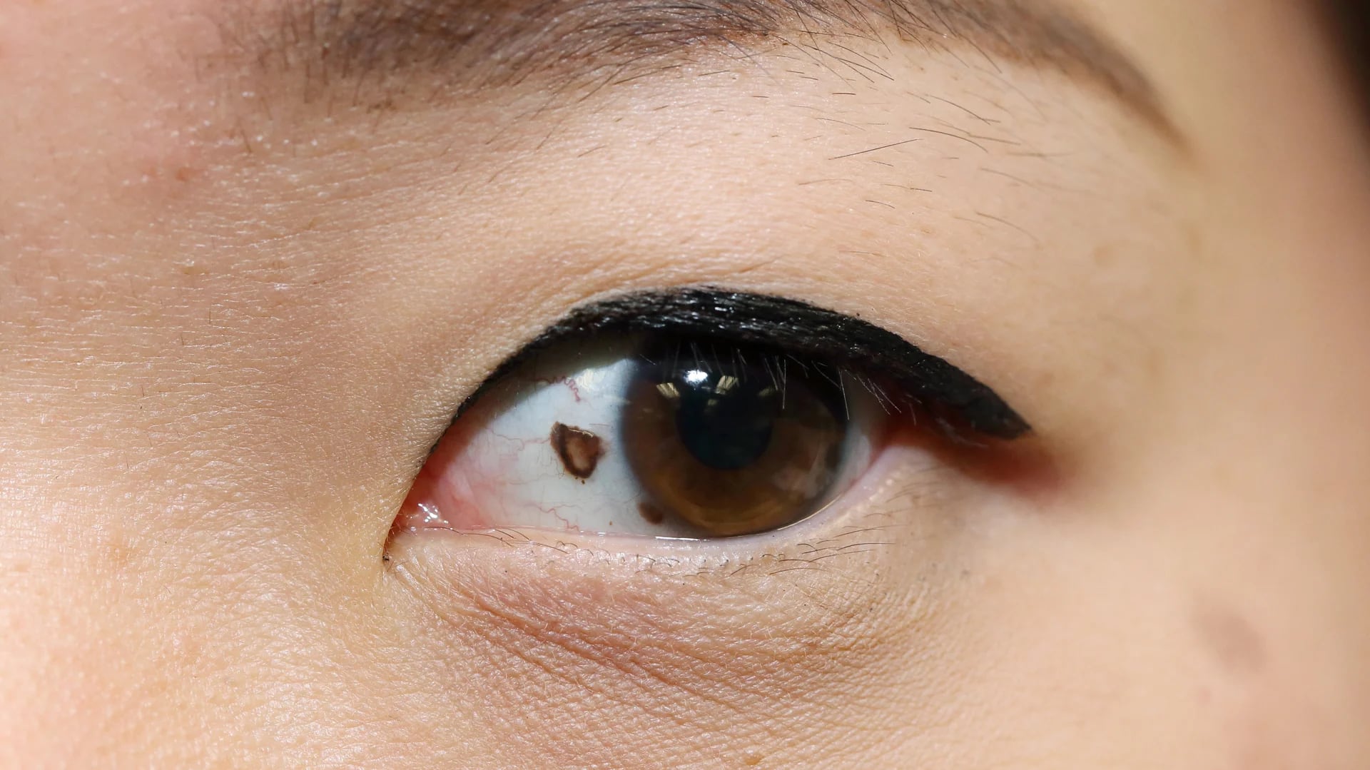 Existe una baja prevalencia de que el melanoma se presente en mucosas, como la del ojo (iStock)