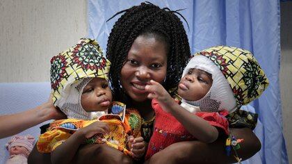 Las siamesas, nacidas en la República Centroafricana, llegaron a Italia en septiembre de 2018 después de que el director del hospital aceptó recibirlas (AFP)