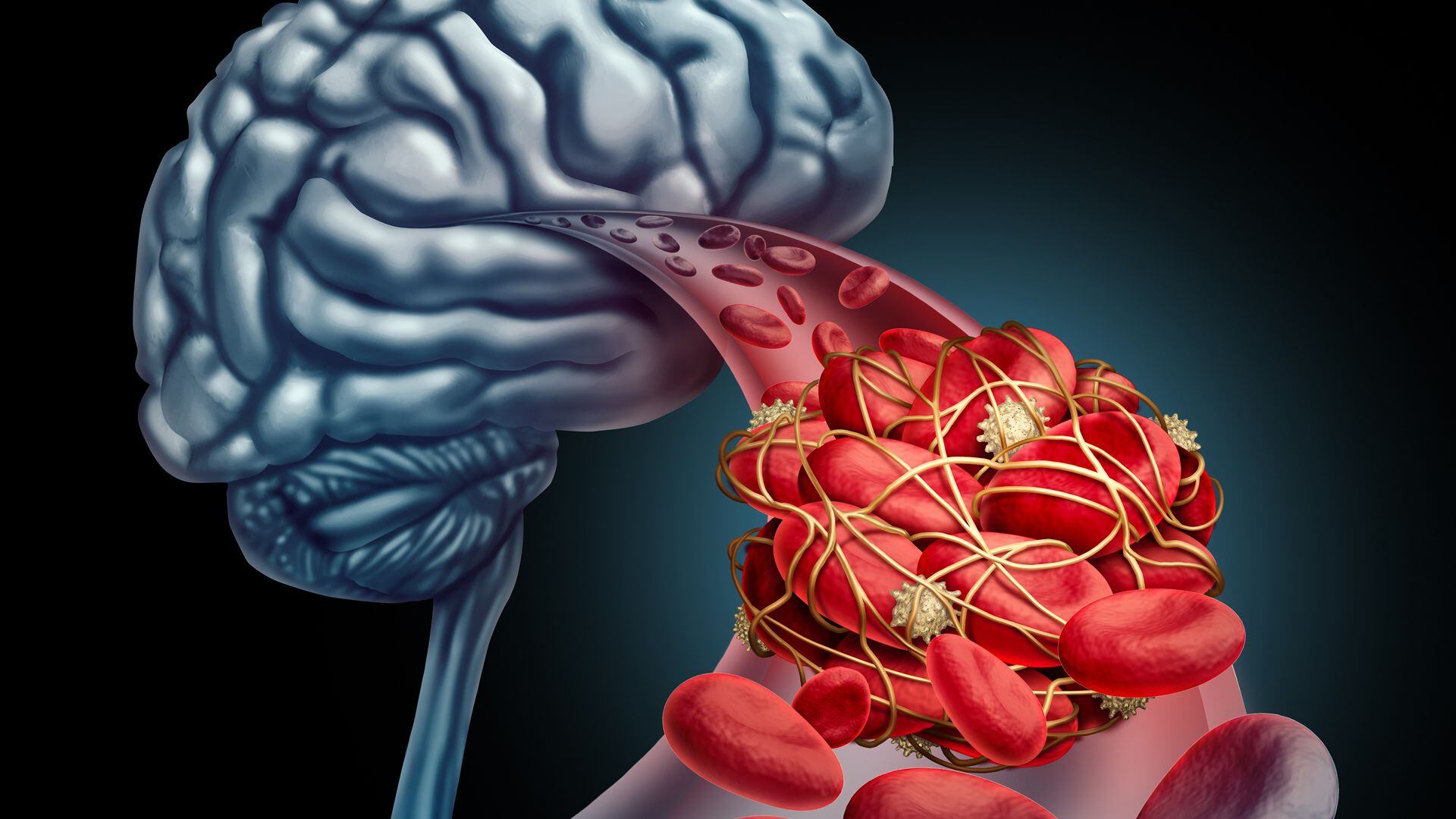 Un accidente cerebrovascular sucede cuando el flujo de sangre a una parte del cerebro se detiene (Getty)